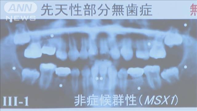 世界初“歯が生える薬”　9月から人への治験開始へ