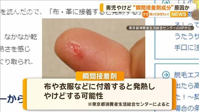 4歳男児やけど　“瞬間接着剤の成分”原因か