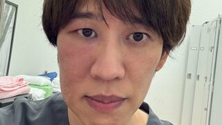 【医者兼芸人】しゅんしゅんクリニックＰさん「丹毒」顔の右半分が赤く腫れ「症例写真で好きに使って」