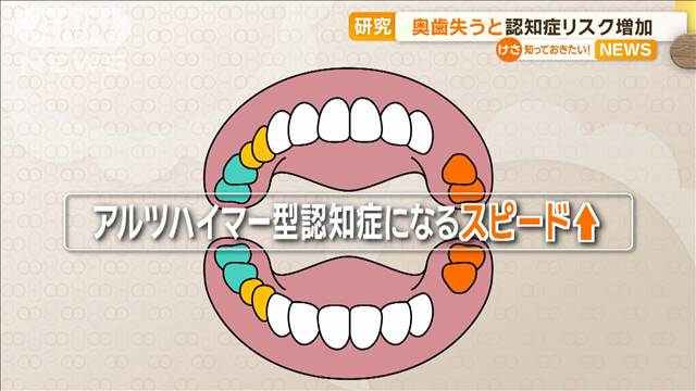 奥歯失うと…「認知症」のリスク増加　2万2000人に調査　九州大の研究グループ