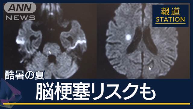 「ろれつ回らなくなり」熱中症だけでなく“脳梗塞”リスクも増加“災害級”暑さ続く　