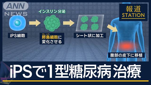 来年2月にも移植…iPS細胞で『1型糖尿病』治験へ　2030年以降の実用化目指す　京都大