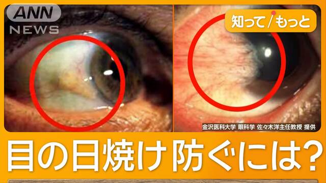 「目の日焼け」白内障や老眼に？　紫外線入りやすくなる秋　熱中症で白内障リスク4倍