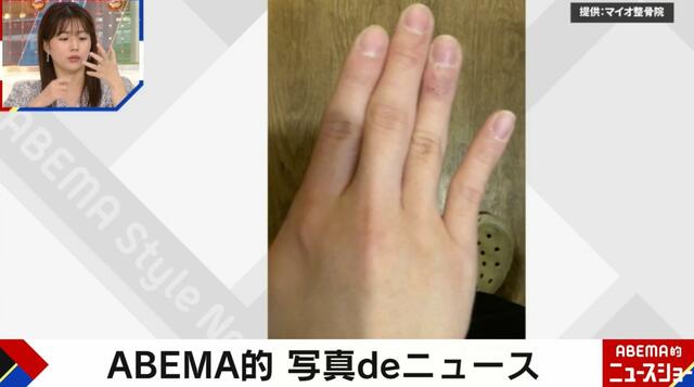 小指が異常に曲がっている…整骨院の“スマホ指”症状写真に衝撃「特に女性に多く見られる」